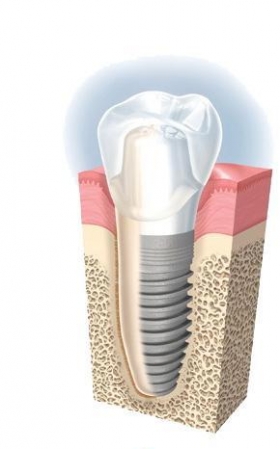 IMPLANTOLOGIA - DentalGN